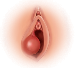 바톨린 낭종 — 분비샘이 막혀 물혹이 형성된 모식도