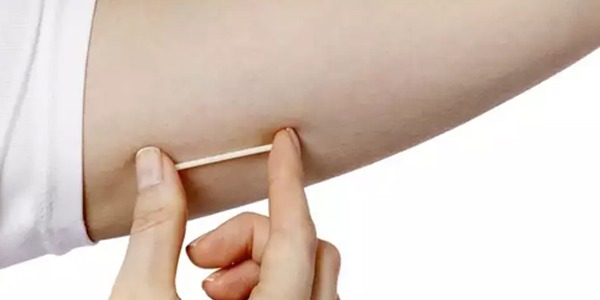임플라논 — 팔 안쪽 피하 이식 시술